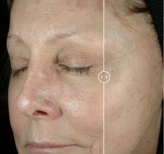 retinol